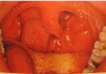 53. Предварительным диагнозом пациента 22 лет с выраженными болями в горле, фебрильной температурой тела в течение 2 дней и данной фарингоскопической картиной будет