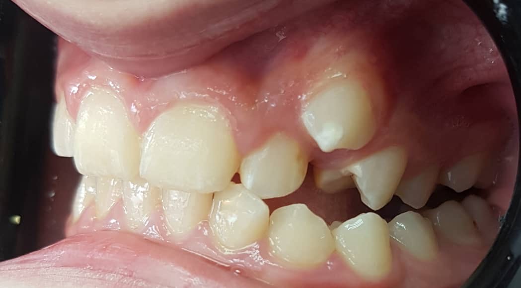 105. Зуб 2.3 имеет аномалию