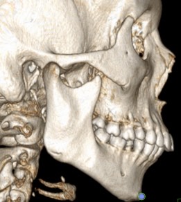 143. На трехмерной реконструкции по компьютерным томограммам представлена точка 2