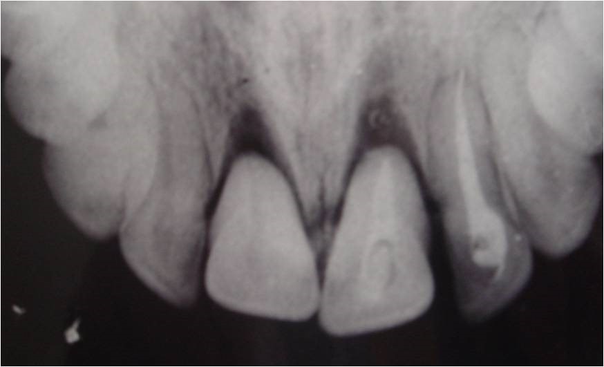 2305. На рентгенограмме у пациента с травмой челюстно-лицевой области дифференцируется ______ зубов