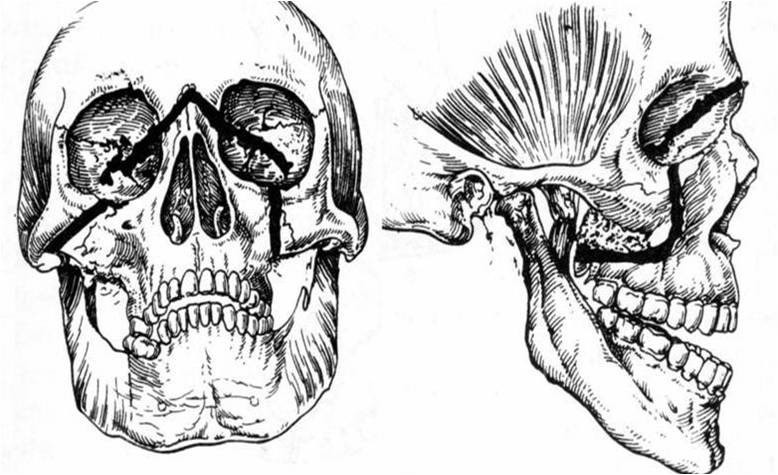 2310. На рисунке у пациента с переломом средней зоны лица представлен перелом