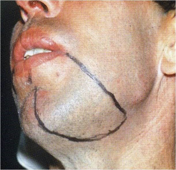 2319. На рисунке у пациента с переломом нижней челюсти слева обозначена