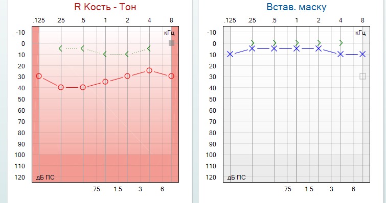 1824. На аудиограмме имеются признаки
