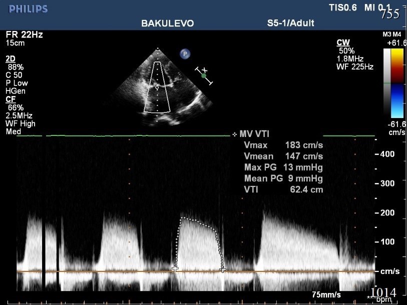 1917. Патологическим состоянием, показанным на эхокардиографическом изображении, является