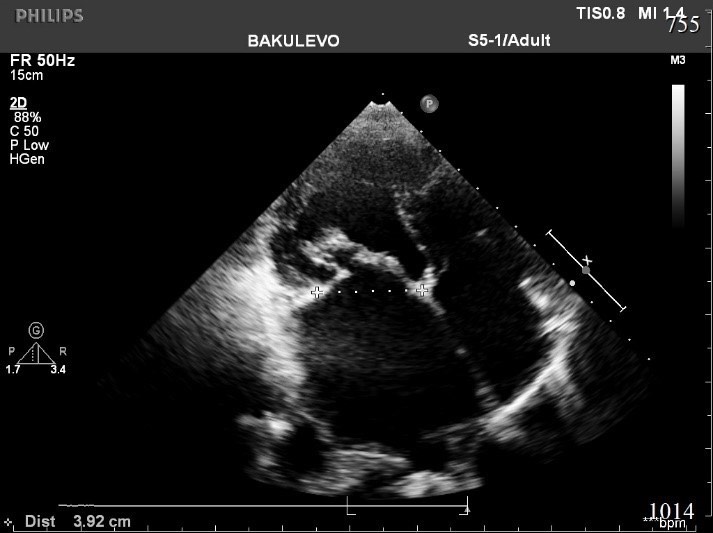 1918. На эхокардиографическом изображении представлен
