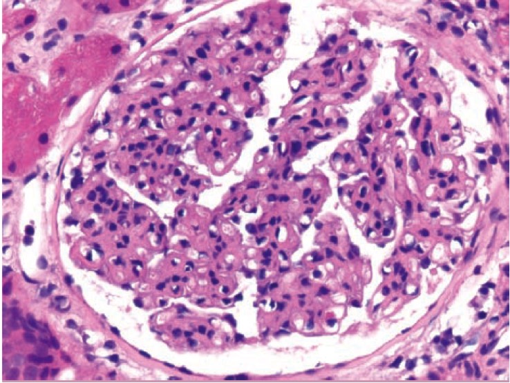 1005. На микрофотографии показан биоптат почки пациентки с активным волчаночным нефритом, обычно иммунные комплексы в нефроне откладываются