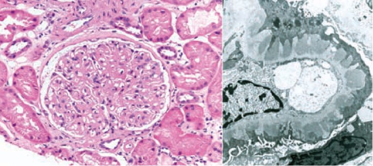1027. Данные биопсии почки 53-летнего мужчины с нефротическим синдромом и соответствующие результаты электронной микроскопии показаны на микрофотографии, наиболее характерен данный паттерн повреждения почки для