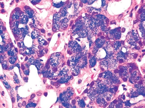 1043. Гистологическое исследование резецированной опухоли околоушной слюнной железы 55-летней пациентки показало, что опухоль преимущественно солидного типа роста, образована клетками с мелкозернистой базофильной цитоплазмой, диагноз ______ более вероятен