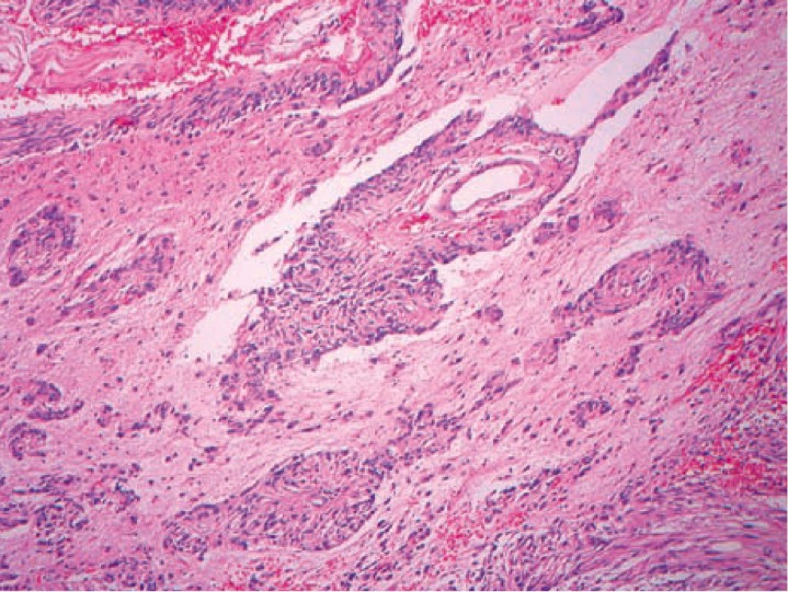 1045. У 15-летней девочки с хронической эпилепсией при обследовании была обнаружена опухоль височной доли, вероятным диагнозом является