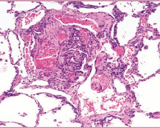 1046. Пациентке 36 лет с одышкой при физической нагрузке и легочной гипертензией в анамнезе выполнили пневмонэктомию, при гистологическом исследовании обнаружены следующие изменения диагноз _____ наиболее вероятен