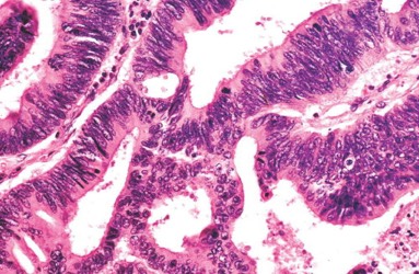 1047. У 65-летнего пенсионера, всю жизнь проработавшего в деревообрабатывающей промышленности, в левой решетчатой пазухе обнаружили опухоль железистого строения диагноз _____ более вероятен