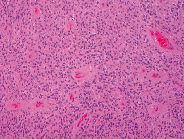 1048. Наиболее частой локализацией опухоли, показанной на микрофотографии, считают