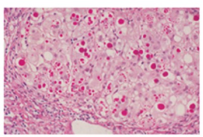 1051. Месячному ребенку поставили диагноз гепатит новорожденных, по результатам лабораторных исследований фракция конъюгированного билирубина составляет более 50% от общего билирубина, уровень сывороточной щелочной фосфатазы заметно увеличивается, выполнена биопсия печени c последующим pas-окрашиванием препарата, диагноз _____ наиболее вероятен