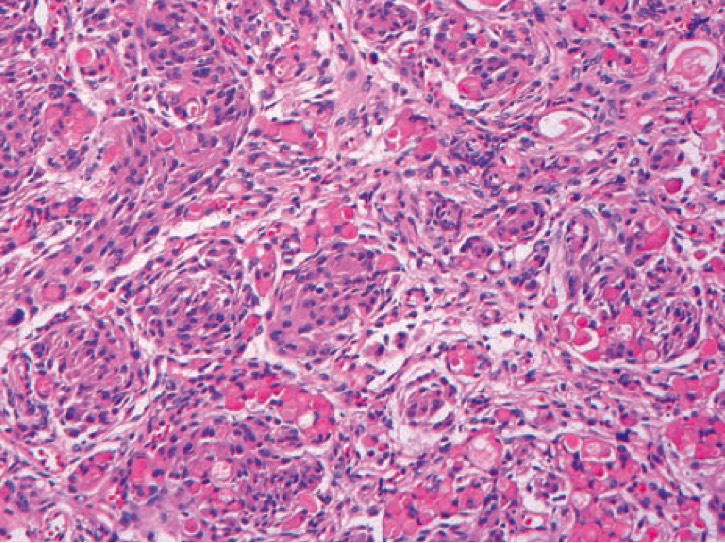 1054. На микрофотографии изображена опухоль, которая располагалась у 72-летней пациентки в проекции лобной доли, но не была с ней связана, диагноз