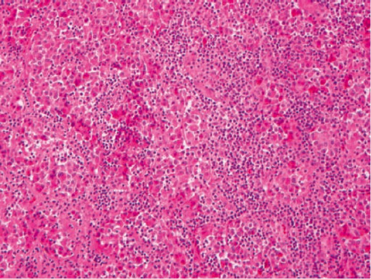 1066. 32-Летней недавно родившей пациентке выполнили биопсию гипофиза вследствие симптомов его недостаточности диагноз