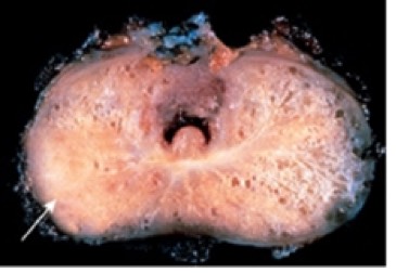 1068. Стрелкой указано изменение, обнаруженное в предстательной железе на вскрытии 72-летнего мужчины, в анамнезе жалобы на задержку мочеиспускания, боль в пояснице, при осмотре была точечная болезненность над нижними поясничными позвонками, рентгенограмма нижних поясничных позвонков показала очаговые уплотнения в телах позвонков, данные лабораторных исследований: увеличение сывороточной щелочной фосфатазы и простат-специфического антигена, наиболее вероятной причиной боли в пояснице был