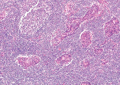 1071. У 40-летней пациентки с жалобами на сухость глаз и ротовой полости пальпируется увеличенная левая околоушная железа, по данным лабораторных исследований выявлены высокие титры циркулирующих антител к рибонуклеопротеинам, в том числе ss-a (ro) и ss-b (la), на микрофотографии показаны изменения, обнаруженные в биоптатах околоушной и малых слюнных желез, у пациентки есть предрасположенность к развитию лимфомы