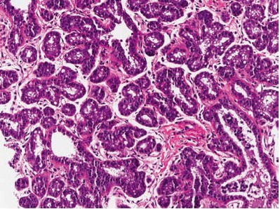 1074. У пациентки 36 лет, с пальпируемым уплотнением в молочной железе и представленным на микрофотографии биоптатом образования, нужно уточнить при сборе анамнеза информацию о