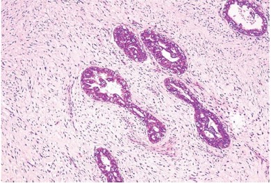 1081. Молодой пациентке выполнили эксцизию плотного узла молочной железы, который достигал 14 см в наибольшем измерении. опираясь на данные гистологического исследования можно предположить диагноз