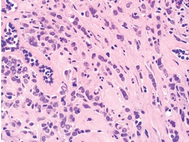 1086. На микрофотографии приведен участок опухоли молочной железы, наиболее вероятным диагнозом является