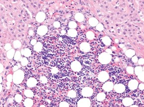 1095. Опухоль надпочечника на разрезе выглядела как округлый узел желтого цвета с участками бурого цвета, без капсулы, 5 см в наибольшем измерении. по гистологическому строению опухоли, приведенному на микрофотографии, диагнозом является