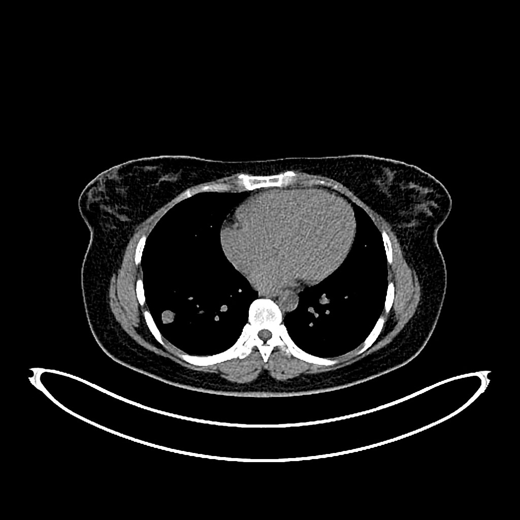 1362. В случае псевдовоспалительной опухоли лёгкого, локализация которой представлена на изображении у пациента пожилого возраста, страдающего инсулиннезависимым сахарным диабетом в стадии субкомпенсации, целесообразно выполнение