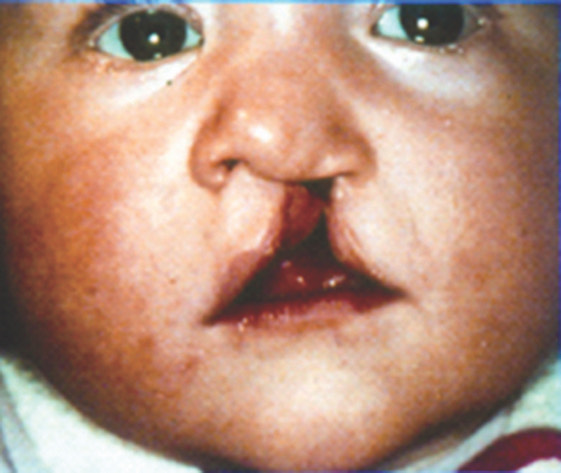 1414. Врожденное несращение верхней губы, альвеолярного отростка и нёба возникает