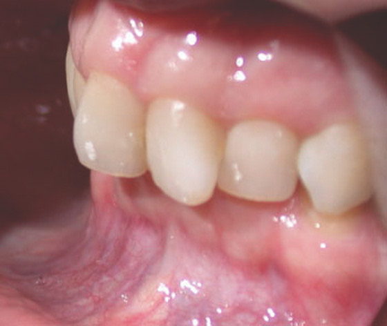 1417. Аномалией положения 1.1 и 2.1 зубов является