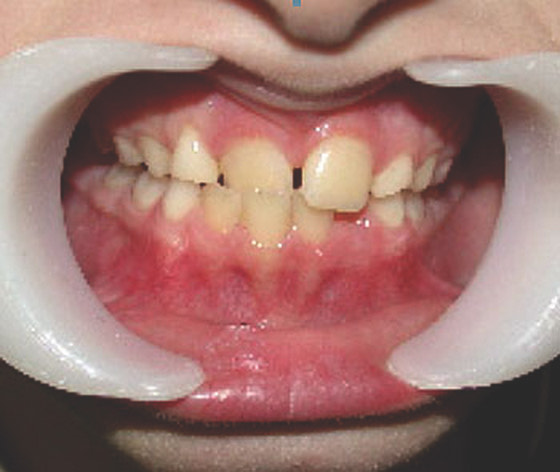 1419. Аномалией положения 1.1 зуба является