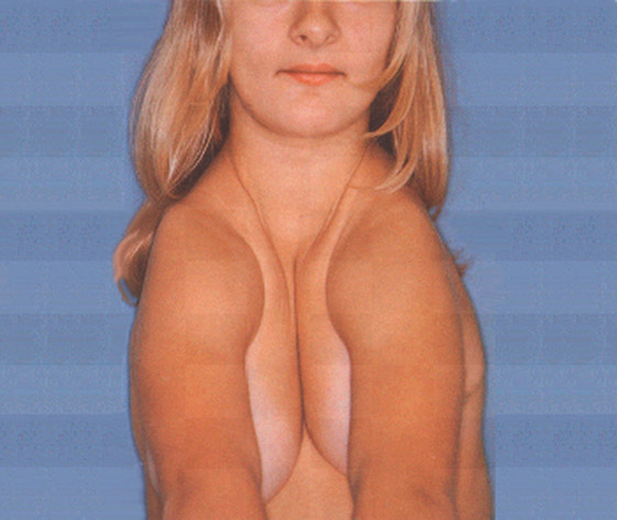 1425. К видам дизостоза относят