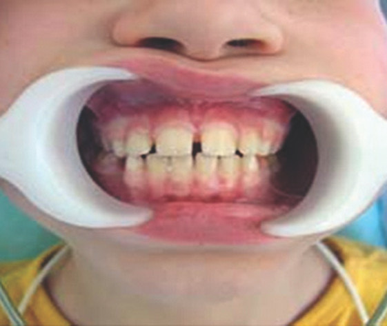 1430. К причине появления диастемы относят