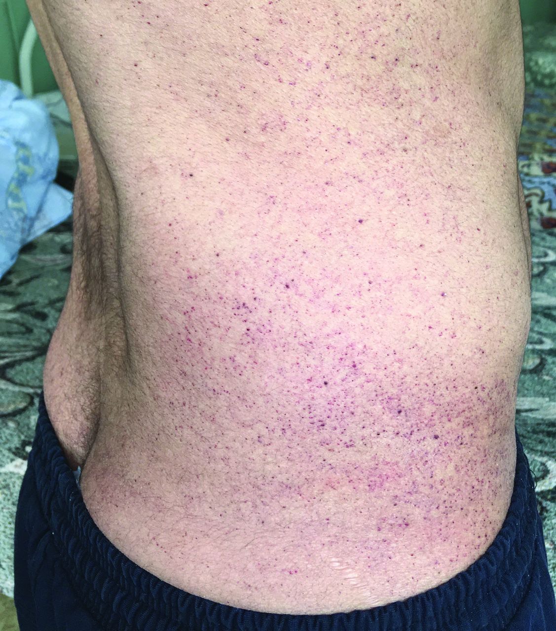 1777. Кожные изменения, представленные на рисунке часто встречаются при