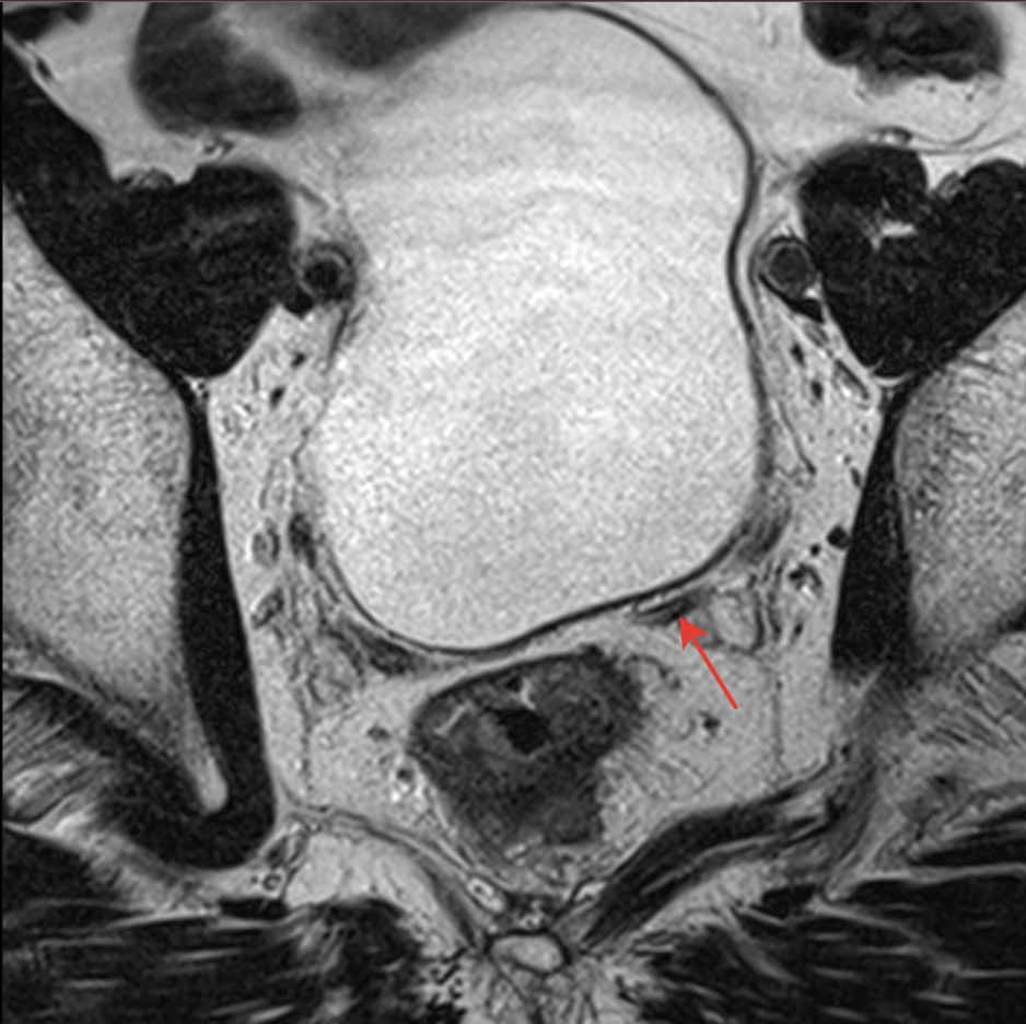 2900. На представленных мр-томограммах органов малого таза стрелкой указан