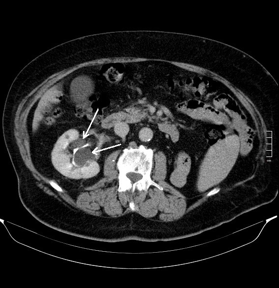 2906. Образования в правой почке, указанные стрелками, являются