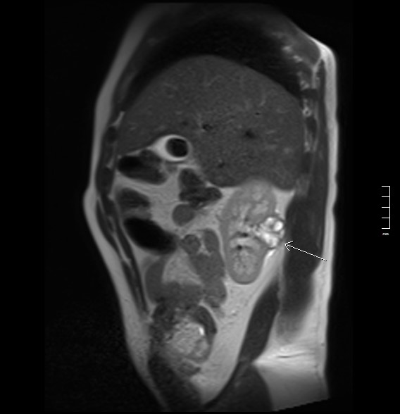 2913. Указанное стрелкой кистозно-солидное образование локализуется в _____ сегменте почки
