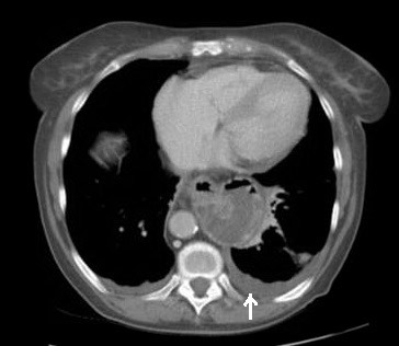 2929. Изменение, обозначенное стрелкой на изображении, указывает на наличие