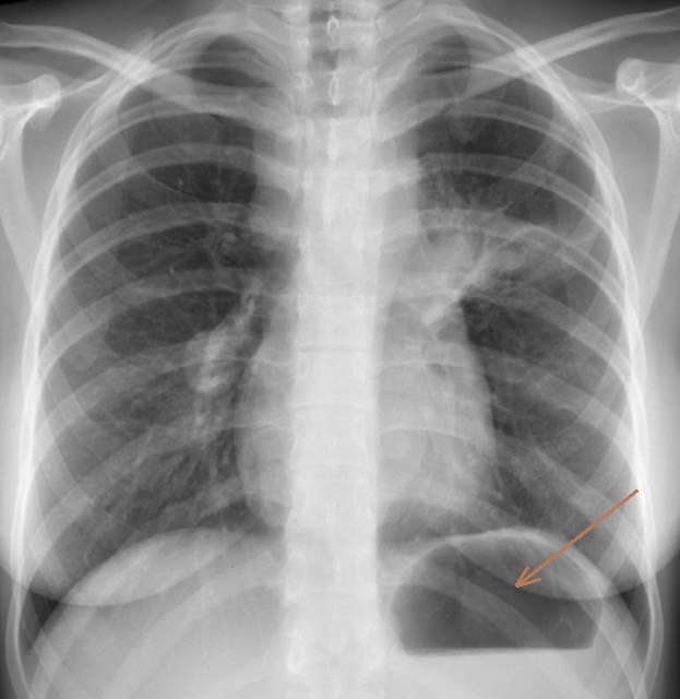 2933. Стрелкой на снимке органов грудной полости в прямой проекции отмечен