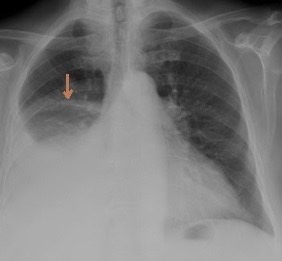 2936. Стрелка на обзорных снимках органов грудной полости отмечает