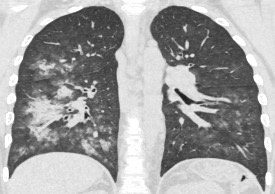 1882. У пациента 14 лет диагноз «лимфома ходжкина», «нодулярный склероз», при выполнении компьютерной томографии определяются участки инфильтрации в правом легком и нижней доле левого легкого, рентгенологическая картина соответствует