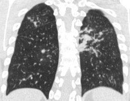 1886. Пациент 18 лет с острым миелобластным лейкозом перенес две аллогенные трансплантации гемопоэтических стволовых клеток в связи с гипофункцией трансплантата, при госпитализации с подозрением на рецидив появилась лихорадка, общая слабость, выполнена компьютерная томография грудной клетки, что соответствует