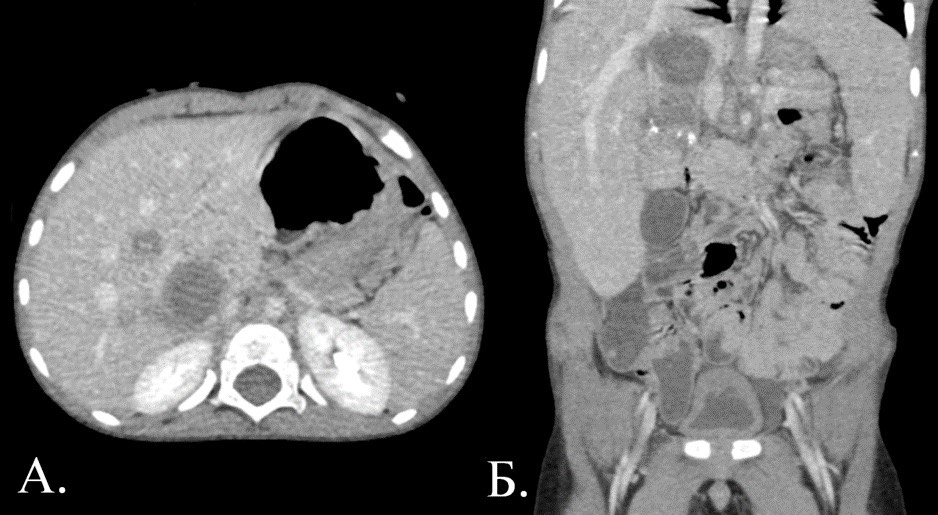 1892. Пациент 3 года (роды на 24 неделе, тяжелое течение беременности, в 2,5 года – лихорадка), альфафетопротеин - 494000 ме/мл, на КТ брюшной полости определяется объемное образование неоднородной плотности с множеством кальцинатов кистозно-солидного строения, на КТ легких - метастатический очаг в s6 правого легкого, картина соответствует