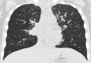 2963. Пациенту 12 лет с диагнозом «приобретенный иммунодефицит: общая вариабельная иммунная недостаточность», состояние после торакоскопической биопсии верхней доли правого легкого выполнена компьютерная томография, рентгенологическая картина соответствует