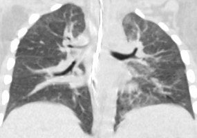 1926. Пациент 2 лет с нейробластомой левого надпочечника после нескольких блоков полихимио- и лучевой терапии и туморадреналэктомии слева, на КТ выявлено снижение пневматизации легочной ткани, диффузно расположенные участки уплотнения легочного интерстиция по типу «лоскутного одеяла», рентгенологическая картина соответствует