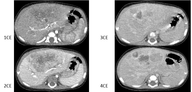 2969. Девочке 4 месяцев выполнена компьютерная томография брюшной полости с контрастным усилением, рентгенологическая картина соответствует