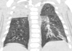 1940. Пациенту 3 месяца с диагнозом «медуллобластома», состояние после оперативного вмешательства и полихимиотерапии, выполнена компьютерная томография, рентгенологическая картина соответствует