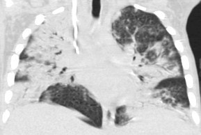 1946. У пациента 10 лет с нейтропенией при компьютерной томографии в легких определяются массивные зоны уплотнения легочной ткани сливного характера с преимущественным перибронхиальным расположением, корни легких на фоне инфильтратов не дифференцируются, рентгенологическая картина соответствует