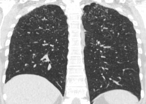 1947. У пациентки 17 лет при выполнении компьютерной томографии легких определяются многочисленные мелкие очаги 1 ‒ 4 мм, в корнях легких визуализируются многочисленные увеличенные бронхопульмональные лимфатические узлы до 16 мм, рентгенологическая картина соответствует