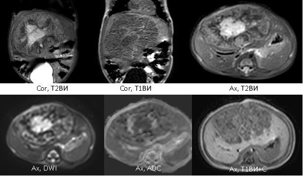 1948. Девочке 2 месяцев выполнена магнитно-резонансная томография брюшной полости с контрастным усилением, рентгенологическая картина соответствует