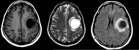 3810. Ребенку 12 лет с жалобами на головную боль, тошноту и судороги выполнена магнитно-резонансная томография, заболеванием, с которым необходимо дифференцировать выявленную рентгенологическую картину, считают