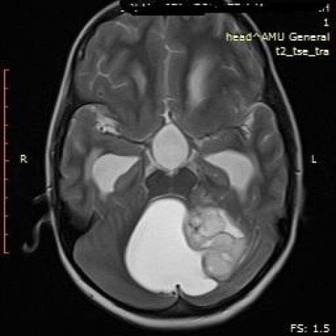 3811. Мальчику 14 лет с головной болью, дисметрией и адиадохокинезом выполнена магнитно-резонансная томография, заболеванием, которое может соответствовать клинико-рентгенологической картине, считают